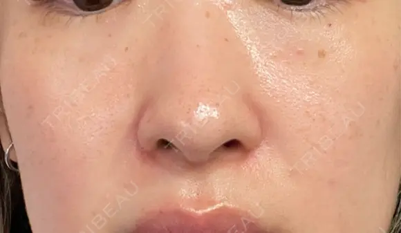 ルメッカ / LDM・インテンスウルトラ Chloe Cheongdam Clinic （クロエチョンダムクリニック） DAY 8 メイン用