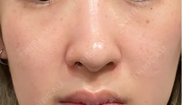 ルメッカ / LDM・インテンスウルトラ Chloe Cheongdam Clinic （クロエチョンダムクリニック） DAY 9 メイン用