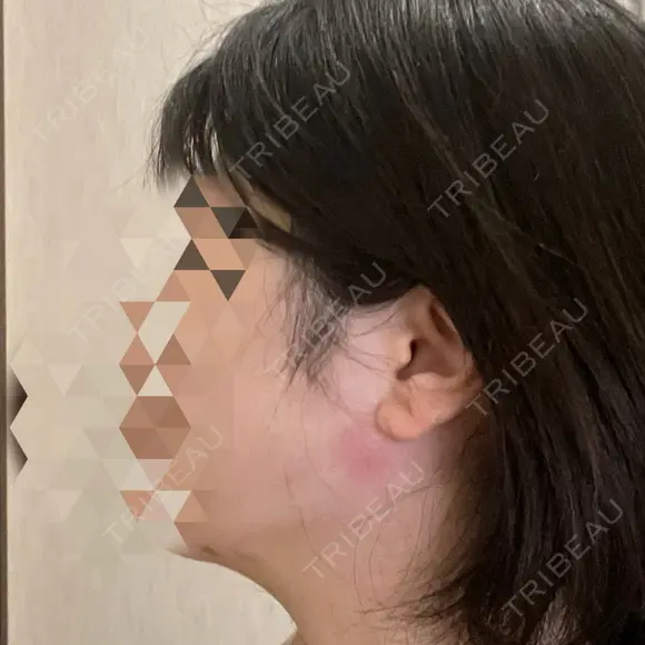 糸リフト / 脂肪吸引注射（顔） / ボトックス（あご） / ボトックス（エラ・小顔） / ボトックス（肩） TCB東京中央美容外科 立川院 DAY 4 メイン用