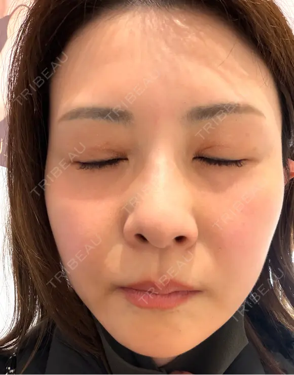 肌育注射（ジュベルックなど） / その他（肌） けやき美容クリニック 沼津院 DAY 4 メイン用