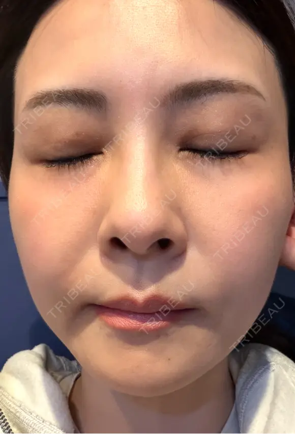 肌育注射（ジュベルックなど） / その他（肌） けやき美容クリニック 沼津院 DAY 6 メイン用