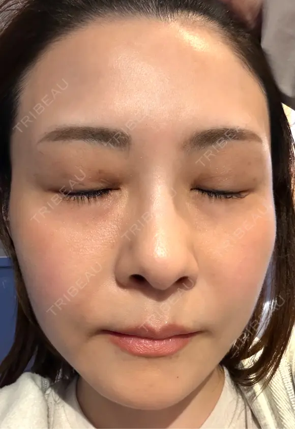 肌育注射（ジュベルックなど） / その他（肌） けやき美容クリニック 沼津院 AFTER メイン用