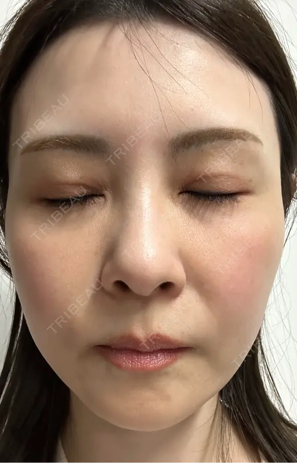 ダーマペン けやき美容クリニック 沼津院 DAY 7 メイン用