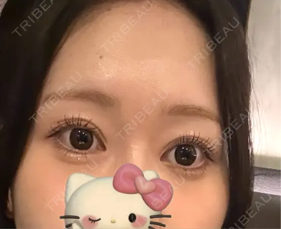 二重埋没 / 目尻切開 / 自然癒着法 Stand by Beauty Clinic AFTER メイン用