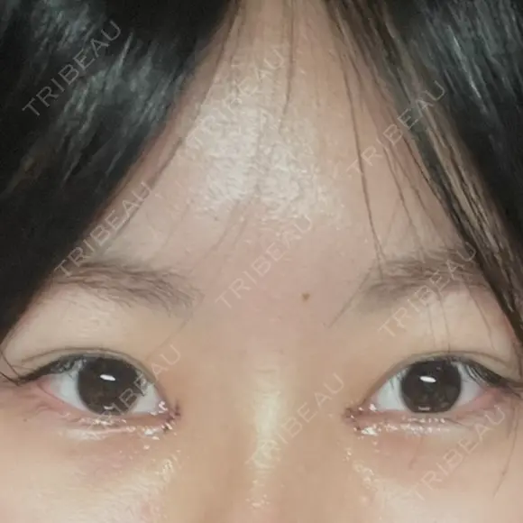 目頭切開 HAAB×DREAM BEAUTY CLINIC 大阪梅田院 DAY 2 メイン用