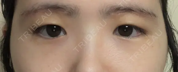 上まぶたの脂肪取り / 眉下切開 新宿美容外科ネビュラクリニック DAY 14 メイン用