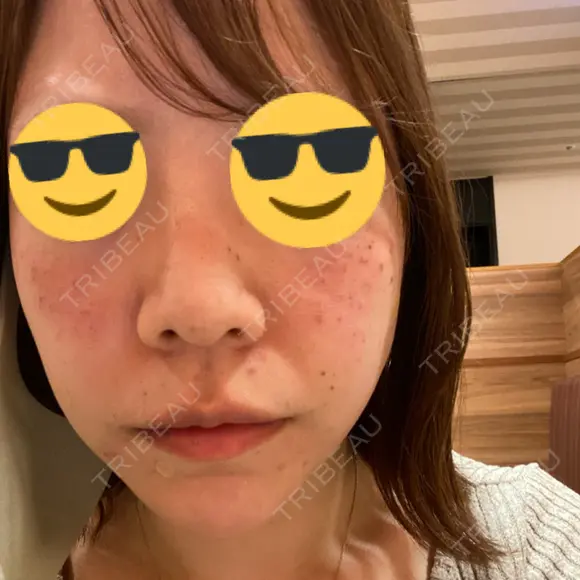 ほくろ・いぼ除去レーザー（肌） / ピコスポット Fellez Clinic【フェルズクリニック】 DAY 0 メイン用