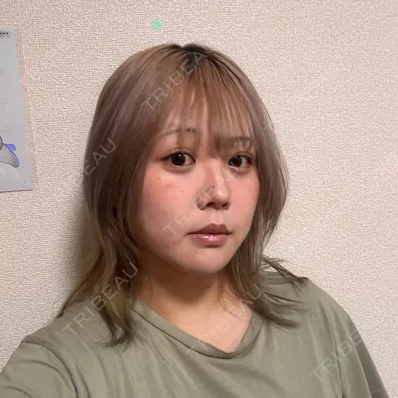クマ治療 / 脂肪吸引（顔） 新宿美容外科ネビュラクリニック AFTER メイン用