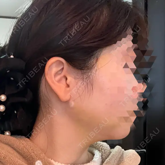 糸リフト / 脂肪吸引注射（顔） / ボトックス（あご） / ボトックス（エラ・小顔） / ボトックス（肩） TCB東京中央美容外科 立川院 DAY 5 メイン用