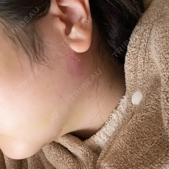 糸リフト / 脂肪吸引注射（顔） / ボトックス（あご） / ボトックス（エラ・小顔） / ボトックス（肩） TCB東京中央美容外科 立川院 DAY 5 メイン用