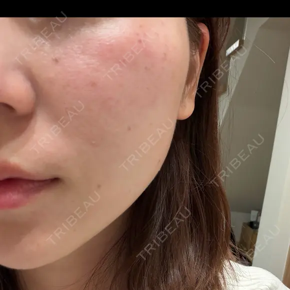 ルメッカ ルラ美容クリニック 札幌本院 DAY 0 メイン用