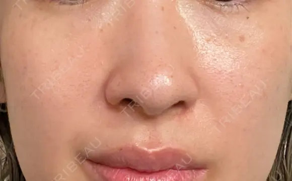 ルメッカ / LDM・インテンスウルトラ Chloe Cheongdam Clinic （クロエチョンダムクリニック） AFTER メイン用