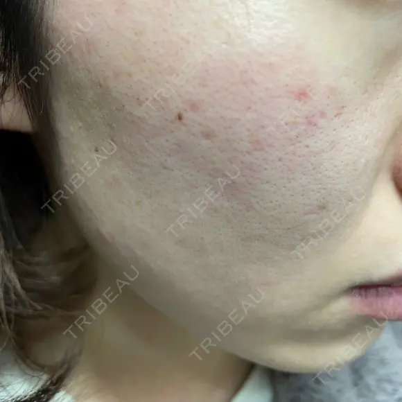 ルメッカ / LDM・インテンスウルトラ Chloe Cheongdam Clinic （クロエチョンダムクリニック） DAY 2 メイン用