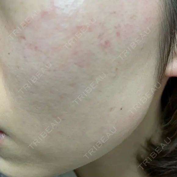 ルメッカ / LDM・インテンスウルトラ Chloe Cheongdam Clinic （クロエチョンダムクリニック） DAY 2 メイン用