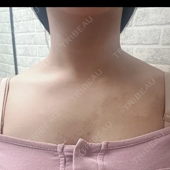 ボトックス（肩） DAILY SKIN CLINIC 福岡院 DAY 2 メイン用