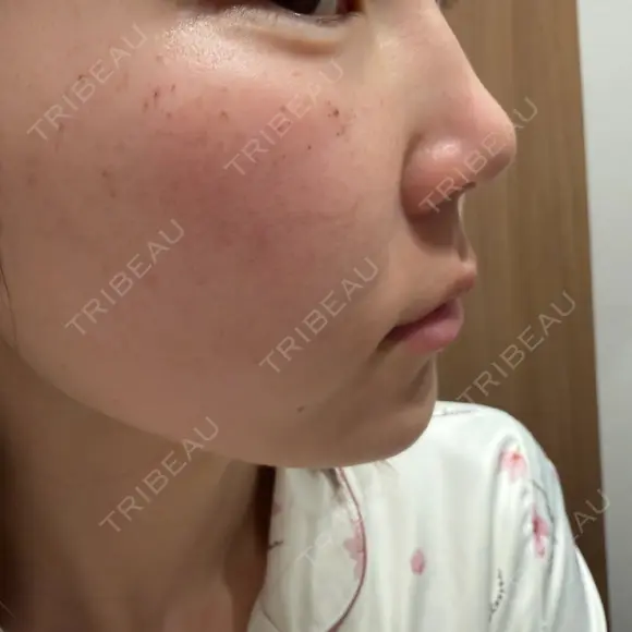 ルメッカ ルラ美容クリニック 札幌本院 DAY 2 メイン用