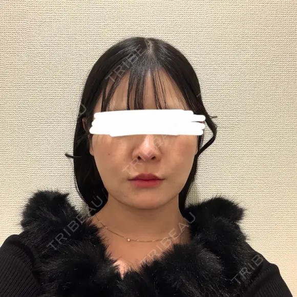 脂肪吸引（顔） ルラ美容クリニック 新宿院 DAY 28 メイン用