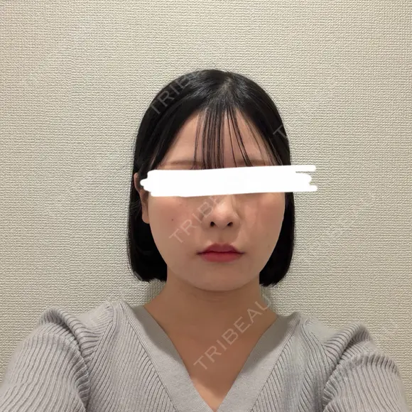 脂肪吸引（顔） ルラ美容クリニック 新宿院 AFTER メイン用