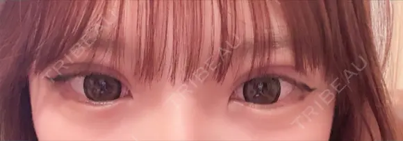 二重埋没 / 上まぶたの脂肪取り アリエル美容クリニック 郡山院 DAY 11 メイン用
