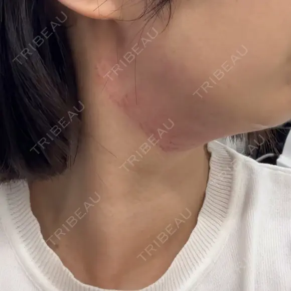 RF（高周波）たるみ治療 / インモード 東京美容皮膚科アロエクリニック池袋 DAY 0 メイン用