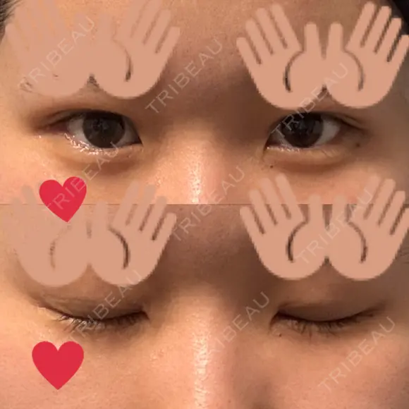 二重埋没 ルラ美容クリニック 渋谷本院 AFTER メイン用