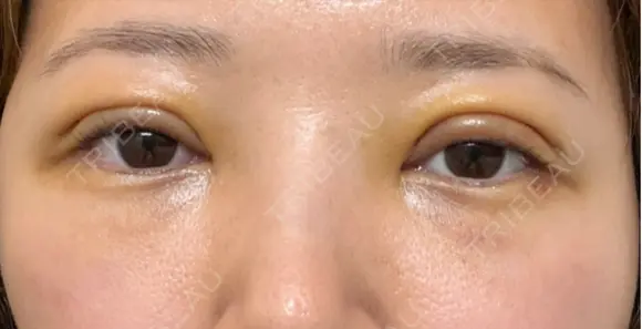 眼瞼下垂（切開） / 下まぶたたるみ取り WOM CLINIC GINZA （ワム クリニック ギンザ） DAY 3 メイン用