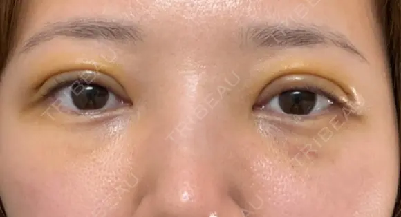 眼瞼下垂（切開） / 下まぶたたるみ取り WOM CLINIC GINZA （ワム クリニック ギンザ） DAY 4 メイン用