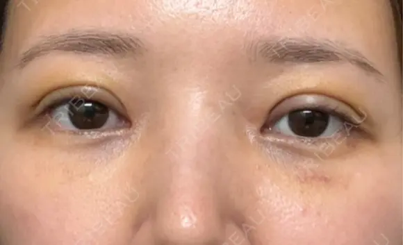 眼瞼下垂（切開） / 下まぶたたるみ取り WOM CLINIC GINZA （ワム クリニック ギンザ） DAY 5 メイン用