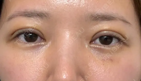 眼瞼下垂（切開） / 下まぶたたるみ取り WOM CLINIC GINZA （ワム クリニック ギンザ） DAY 6 メイン用