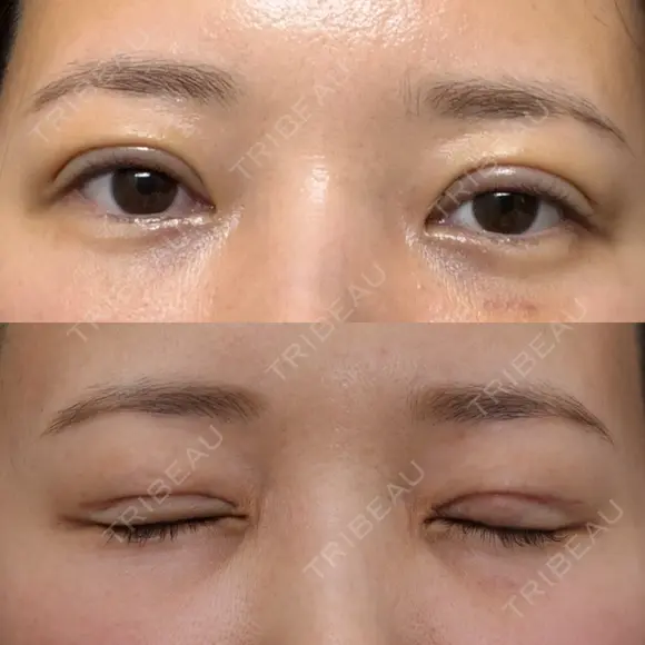 眼瞼下垂（切開） / 下まぶたたるみ取り WOM CLINIC GINZA （ワム クリニック ギンザ） DAY 7 メイン用