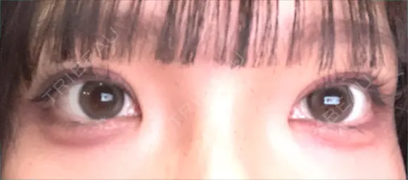 二重埋没 アリエル美容クリニック 水戸院 DAY 14 メイン用
