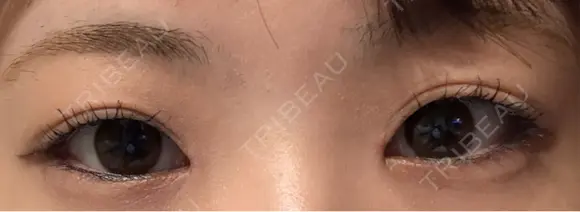 目頭切開 Stand by Beauty Clinic AFTER メイン用