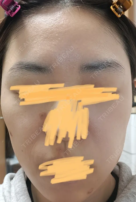 肌育注射（ジュベルックなど） LA MER CLINIC DAY 48 メイン用
