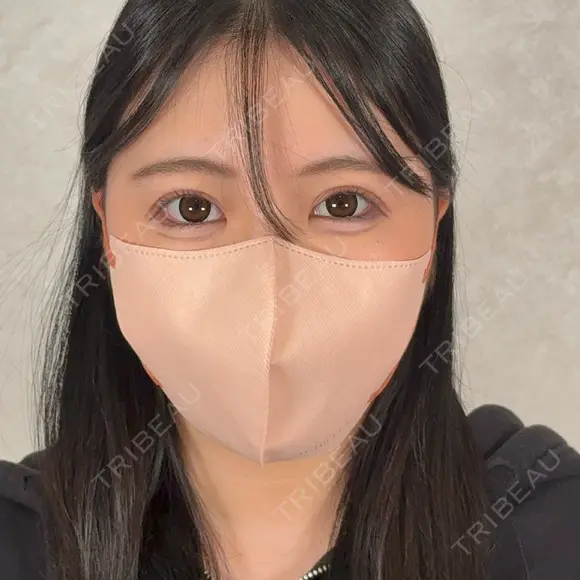 二重埋没 アリエル美容クリニック 横浜院 DAY 11 メイン用
