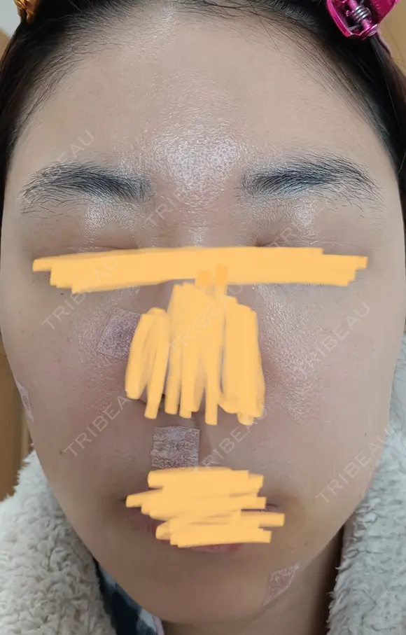 肌育注射（ジュベルックなど） LA MER CLINIC AFTER メイン用