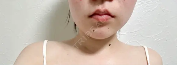 ボトックス（エラ・小顔） / ボトックス（肩） アリエル美容クリニック 水戸院 DAY 23 メイン用