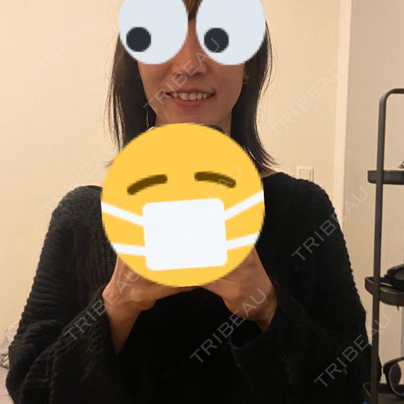 小鼻縮小（切開） / 脂肪注入（額） ASTRA BEAUTY CLINIC AFTER メイン用