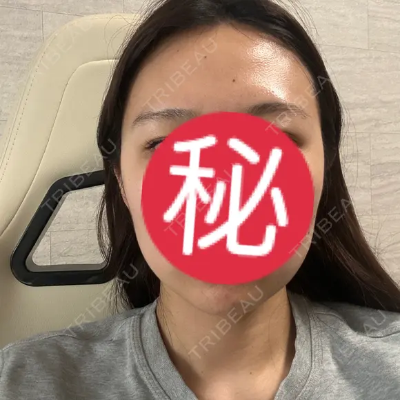 LDM・インテンスウルトラ / デンシティ 湘南美容クリニック 大阪梅田本院 AFTER メイン用