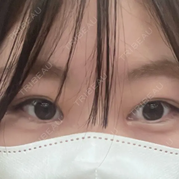 目頭切開 HAAB×DREAM BEAUTY CLINIC 大阪梅田院 AFTER メイン用