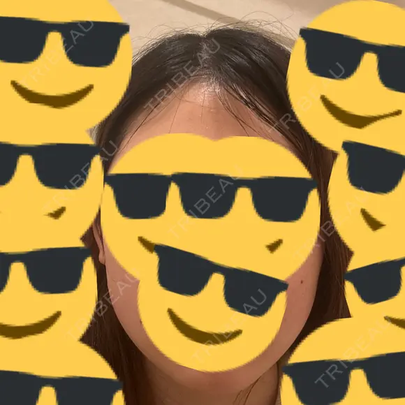 ボトックス（エラ・小顔） Natural Skin Clinic 自由ヶ丘院 DAY 0 メイン用