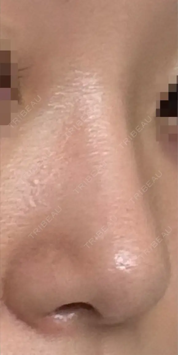 鼻尖形成（切開） / 小鼻縮小（切開） アリエル美容クリニック 大宮院 DAY 47 メイン用