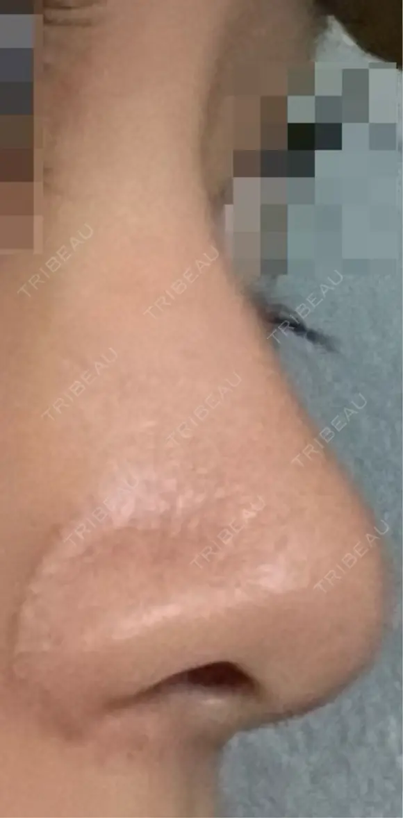 鼻尖形成（切開） / 小鼻縮小（切開） アリエル美容クリニック 大宮院 DAY 47 メイン用