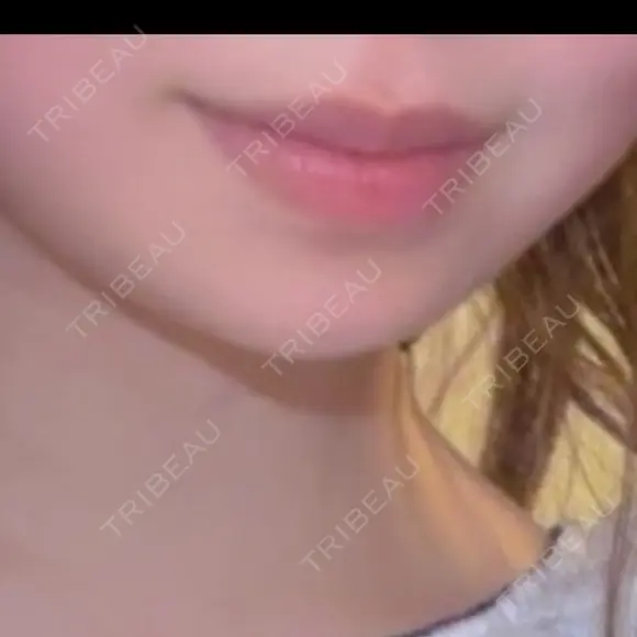 ヒアルロン酸注入（あご） HAAB BEAUTY CLINIC 名古屋院 AFTER メイン用