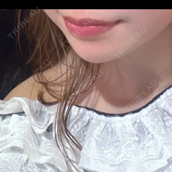 ヒアルロン酸注入（あご） HAAB BEAUTY CLINIC 名古屋院 DAY 3 メイン用