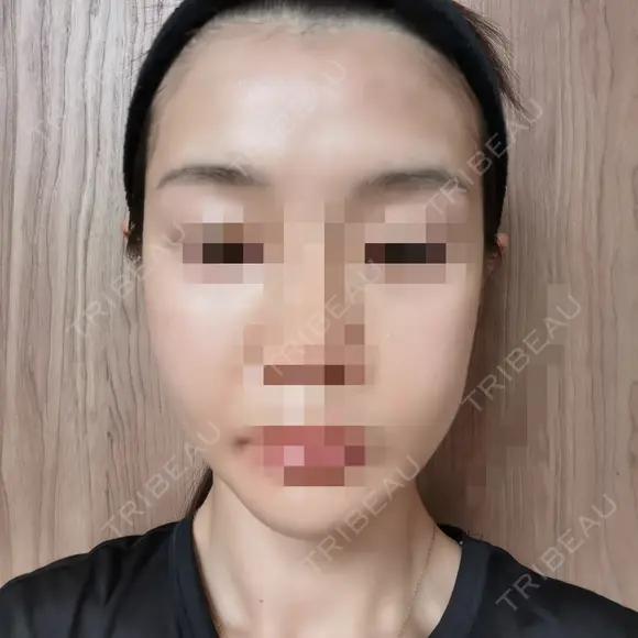 ボトックス（エラ・小顔） 品川美容外科 仙台院 DAY 1 メイン用