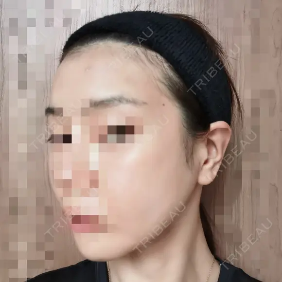 ボトックス（エラ・小顔） 品川美容外科 仙台院 DAY 1 メイン用