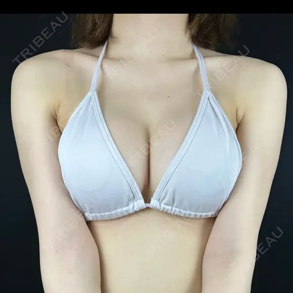 豊胸（シリコンバッグ） 藤・ナチュレ美容クリニック 銀座院 AFTER メイン用