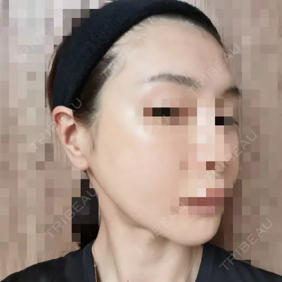 ボトックス（エラ・小顔） 品川美容外科 仙台院 DAY 1 メイン用