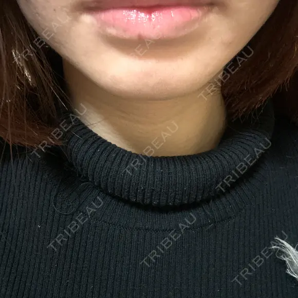 シミ取りレーザー 新宿美容外科クリニック 新宿院 AFTER メイン用