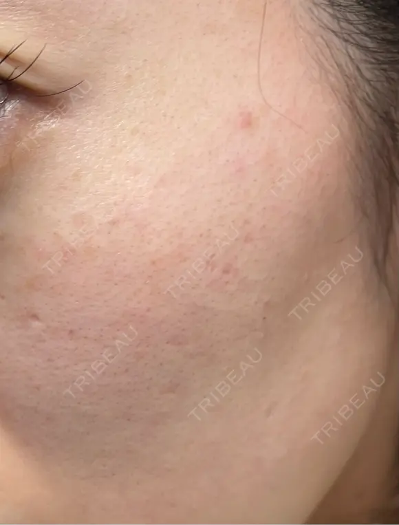 ルメッカ / LDM・インテンスウルトラ Chloe Cheongdam Clinic （クロエチョンダムクリニック） DAY 5 メイン用